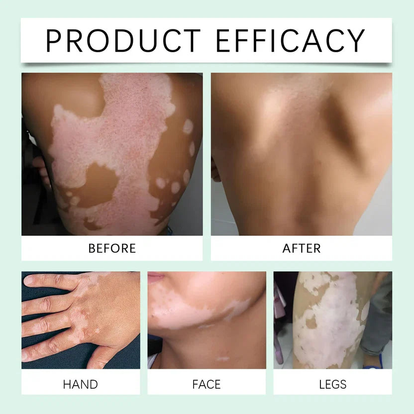 Vitiligo Care Cream