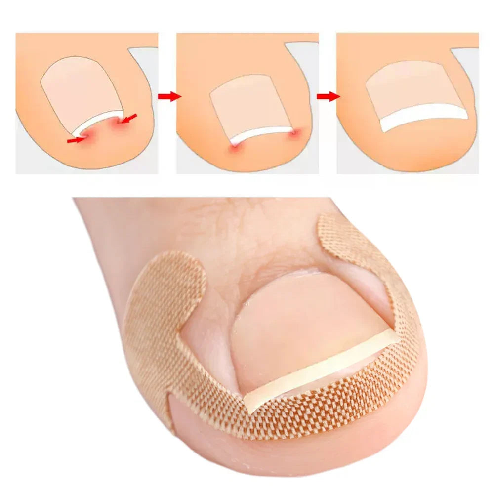 Toenail Correction Strips