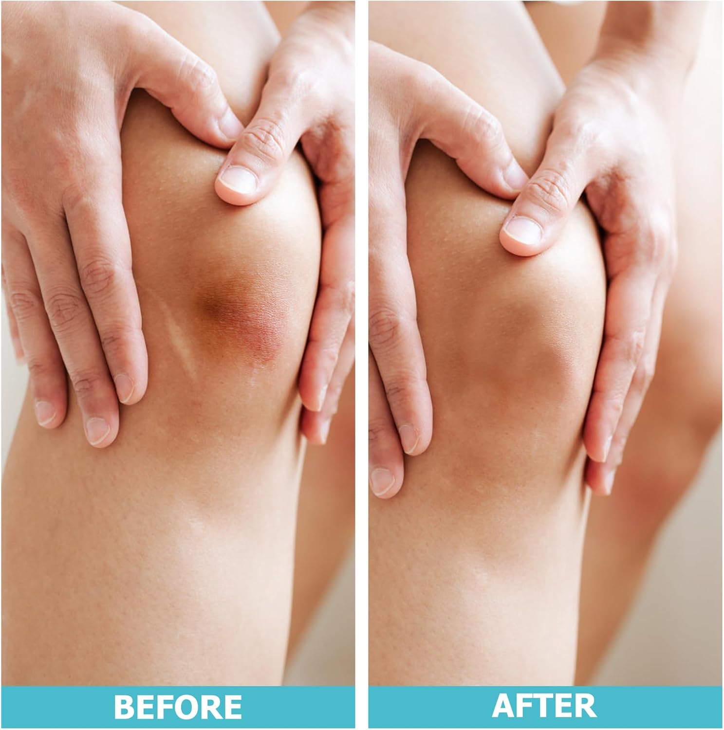 Hydrocolloid Roll for Wound Care